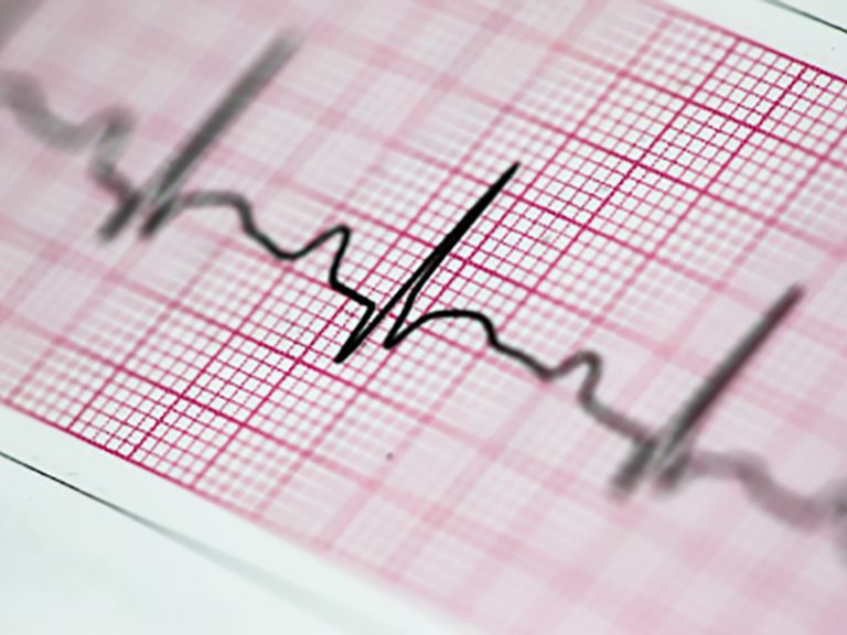 EKG-Diagnostik