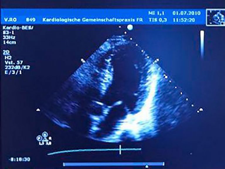 Doppler-Darstellung des Blutflusses im Herzen